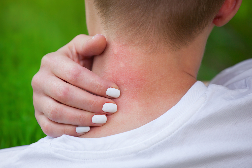 Woman with mosquito bites on back of next because mosquito repellent didn't work